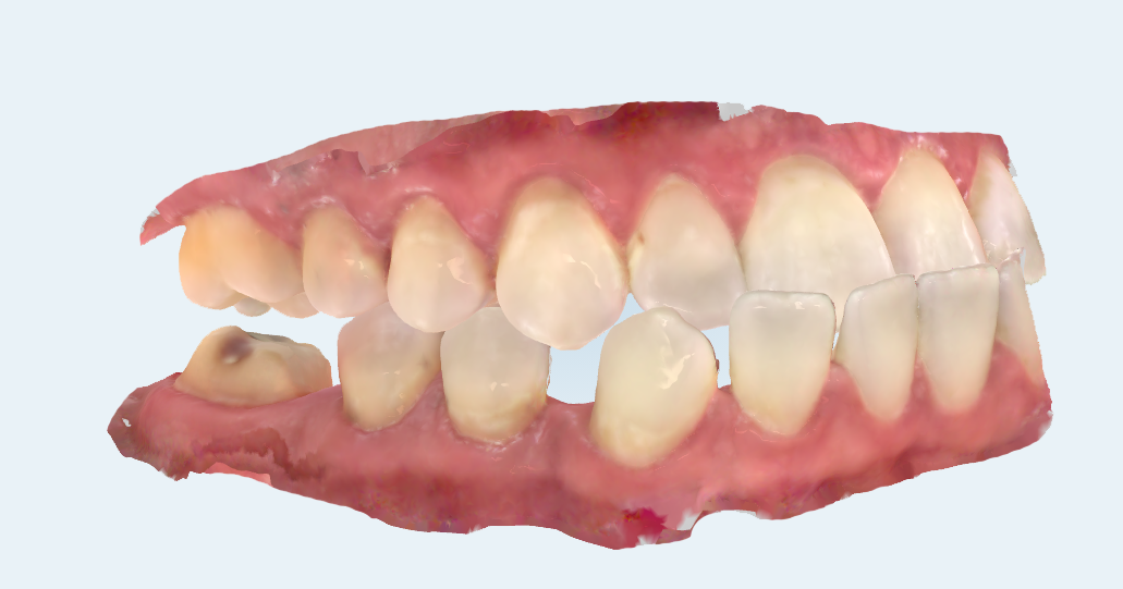 Jaw model showing teeth adjustments