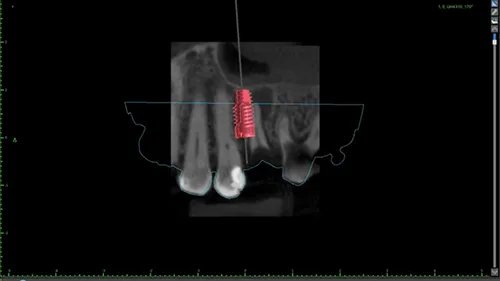 All-on-X Dental Implants